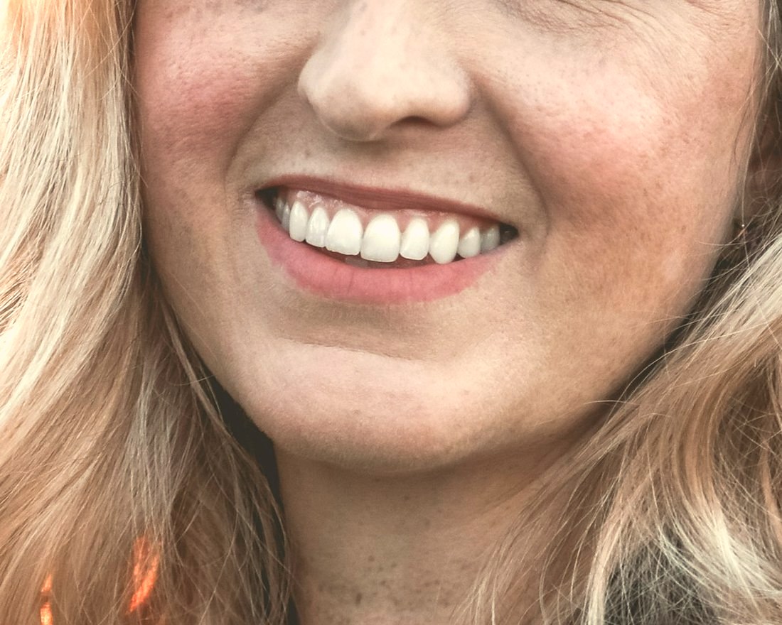 Case 014: smile after eight porcelain veneers