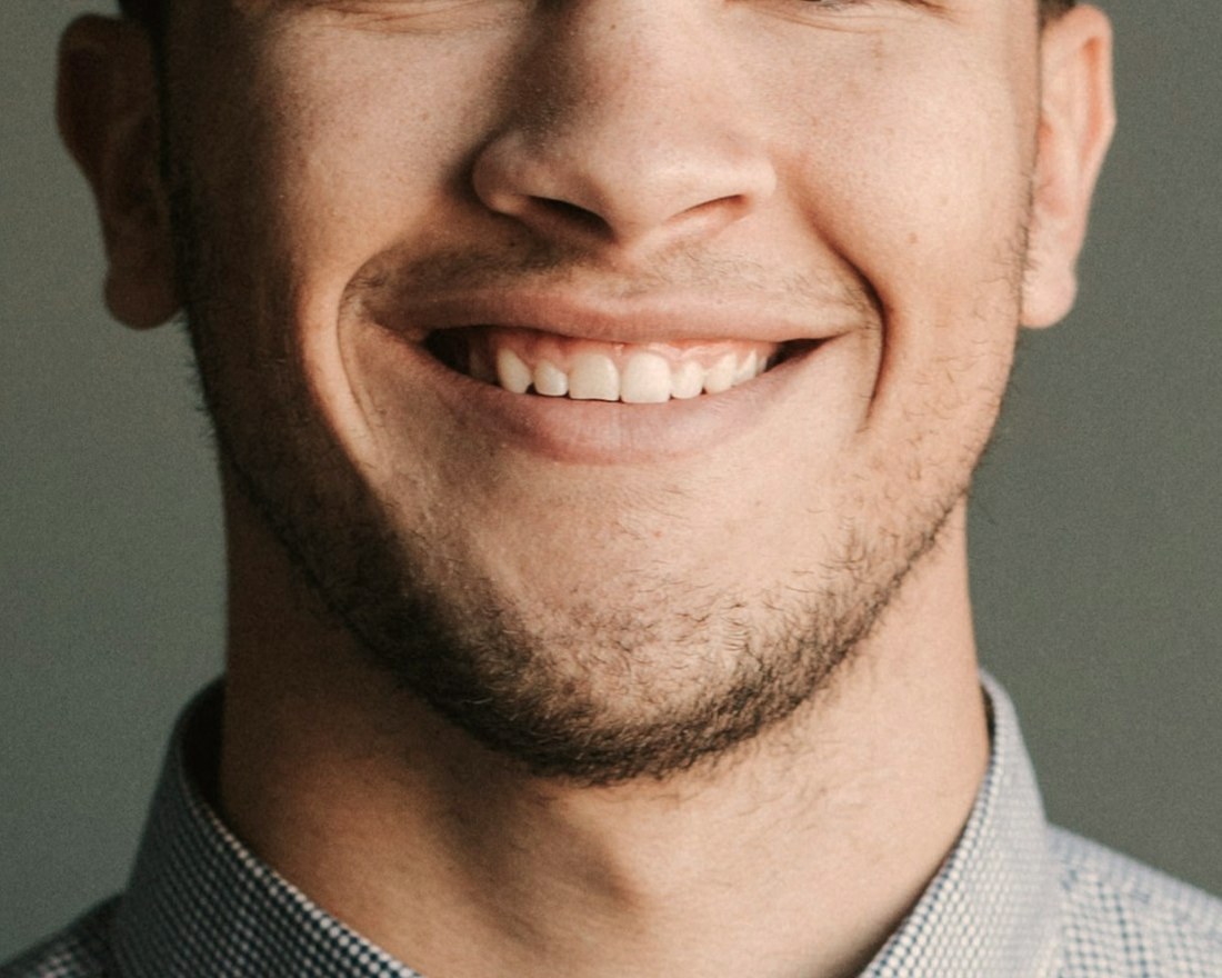 Case 027: smile after clear aligners and bonding