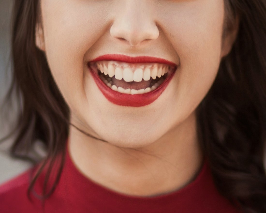 Case 031: smile after gum contouring and whitening